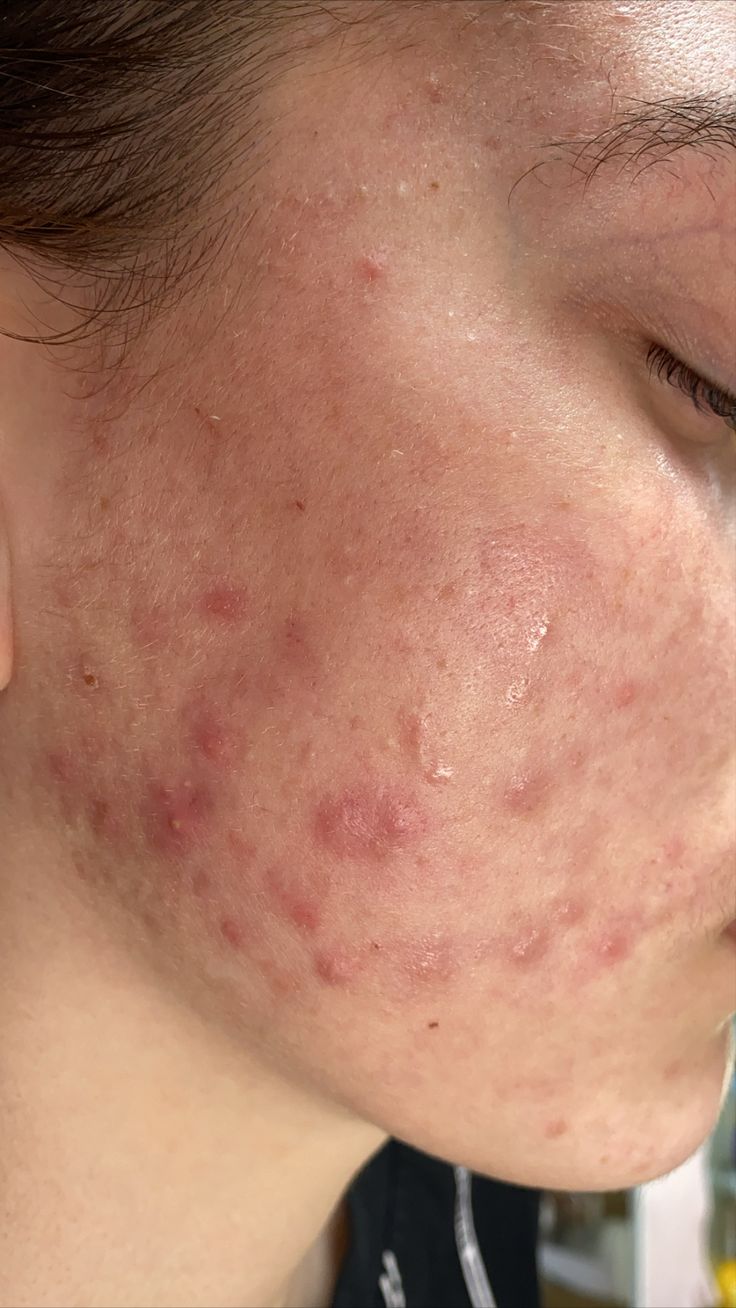 Oravia Healing Marham for skin problems